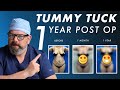 Tummy Tuck 1 Year Post Op Results
