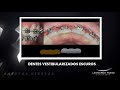 Dentes escuros vestibularizados. Dicas de tratamento