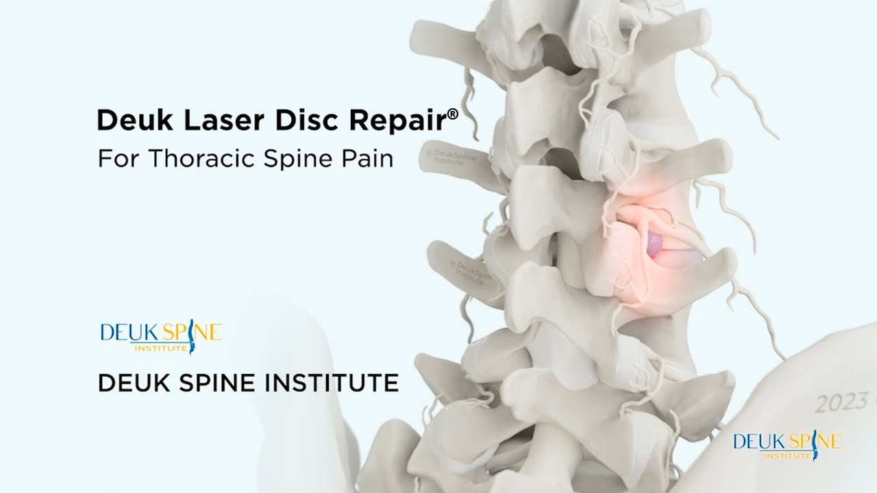 Как вылечить боль в грудном отделе позвоночника с помощью лазерной коррекции межпозвоночных диско...