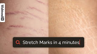 How To Get Rid Of Stretch Marks? Ingredients that work for stretch marks | From Causes To Treatment
