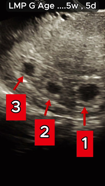 Early Triple Pregnancy - after Ovulation Medications          #ultrasound #pregnant #baby #pcos