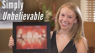 Orthodontics without extraction - now I have a big beautiful smile
