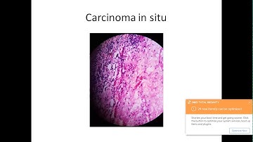 OPHTHALMOLOGY - TOPIC - OCULAR SURFACE SQUAMOUS NEOPLASIA