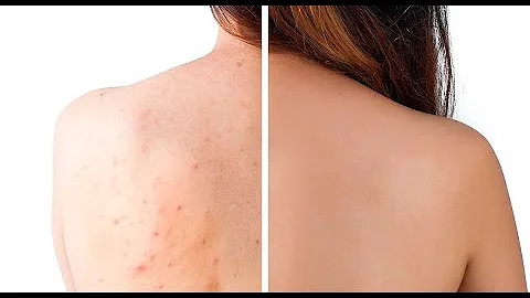 Come eliminare macchie di brufoli sulla schiena?