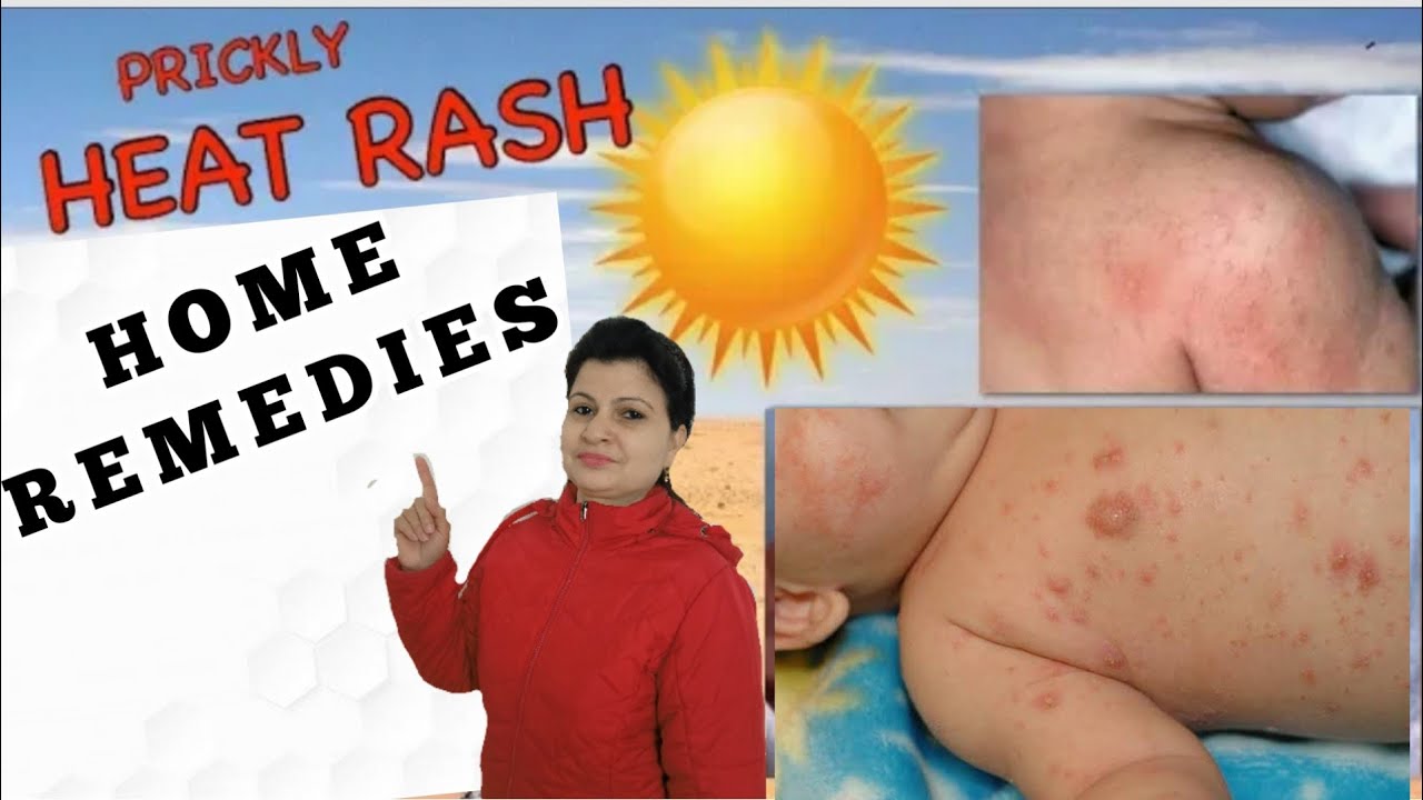 Prickly heat rashes in babies home remedies in hindi Baccho ki