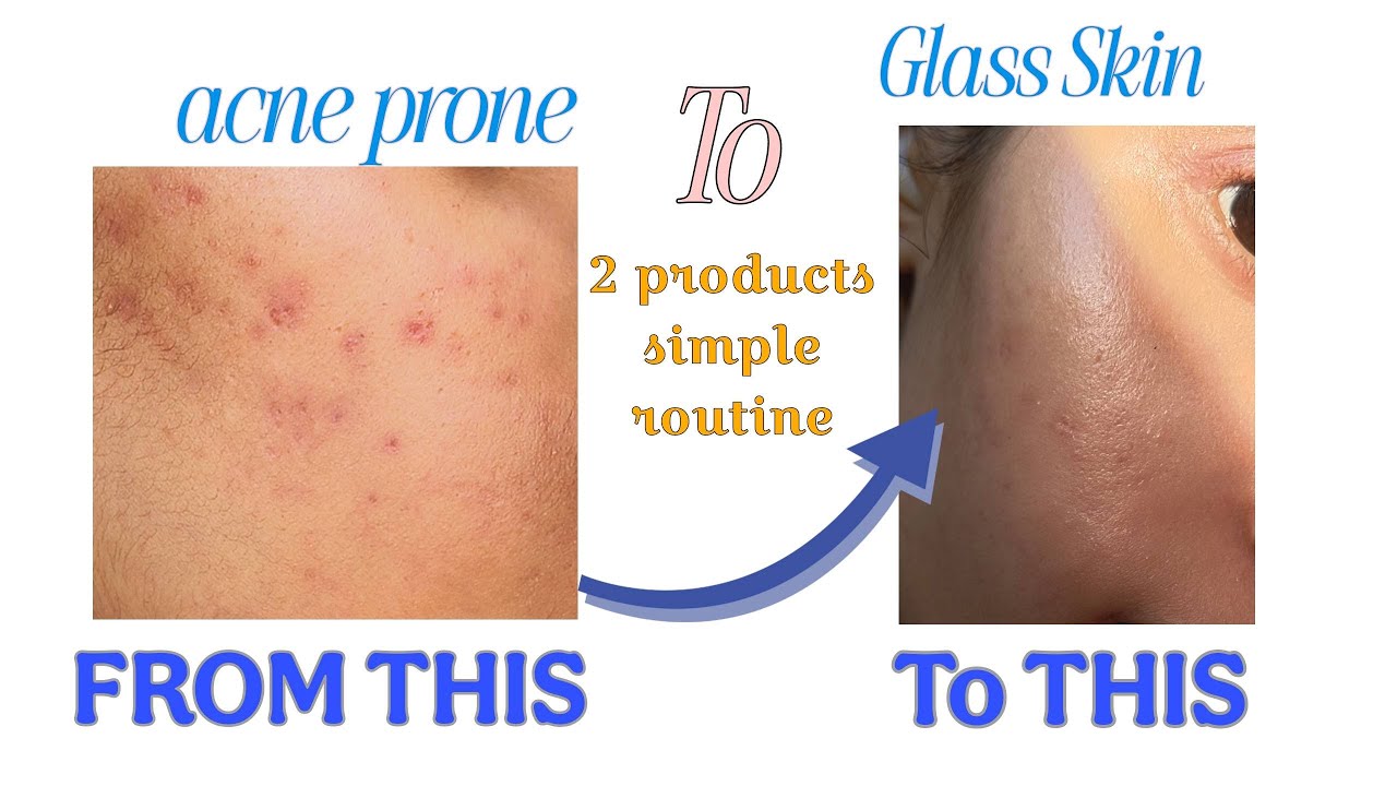 Simple Glass skin duo routine for acne prone skin Now in India! 