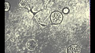 Cancer-associated fibroblast lead tumor cells