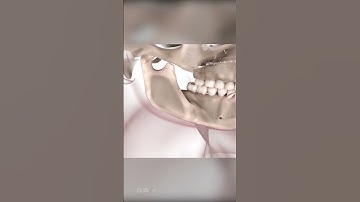 Corrective Jaw Surgery: Orthognathic Surgery