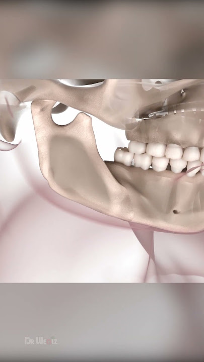 Corrective Jaw Surgery: Orthognathic Surgery