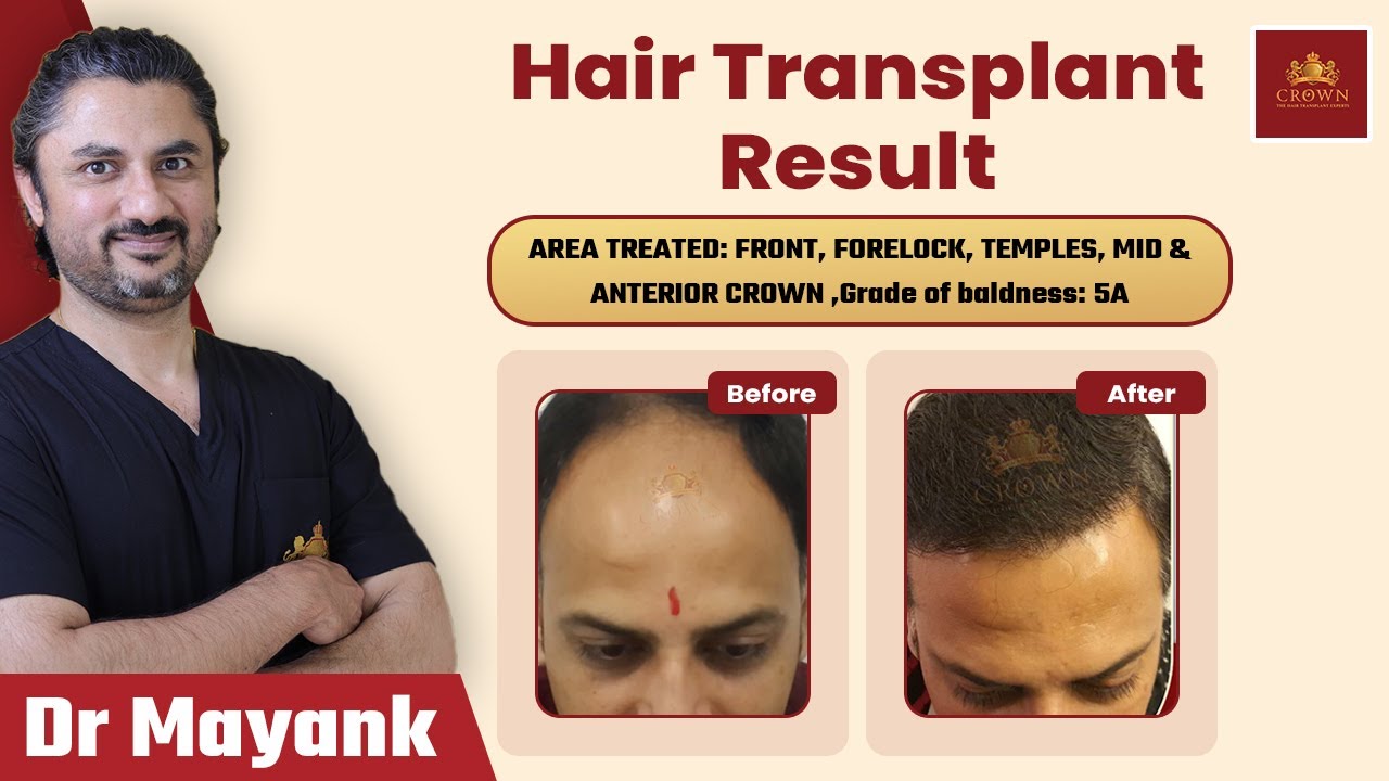 Hair Transplant Results Before and After Hair Transplant Cost in