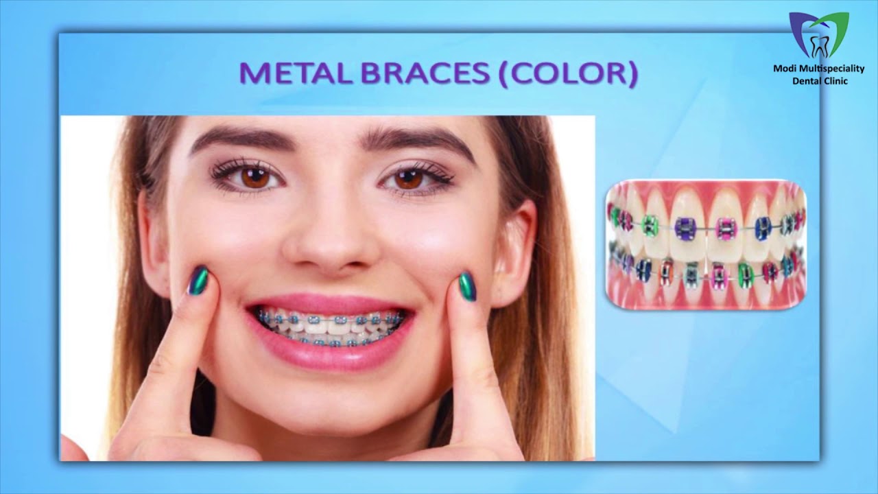 ORTHODONTIC TREATMENT AT MODI MULTISPECIALITY DENTAL CLINIC, VASTRAPUR