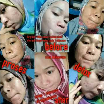 REVIEW PEMAKAIAN RK GLOW ACNE SERIES