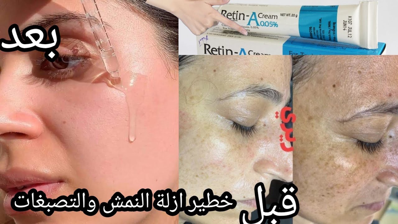 بغيتي تهناي من الكلف والنمش عليك بهاد برودوي الخطير غادي يهنيك كيف ما هناني