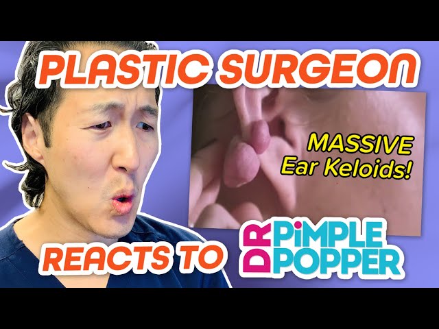 Lift Plastic Surgery - This is a 24-year-old Male patient who got his ears  pierced 1 year ago and since then began developing massive keloids - even  after removing his earrings. The