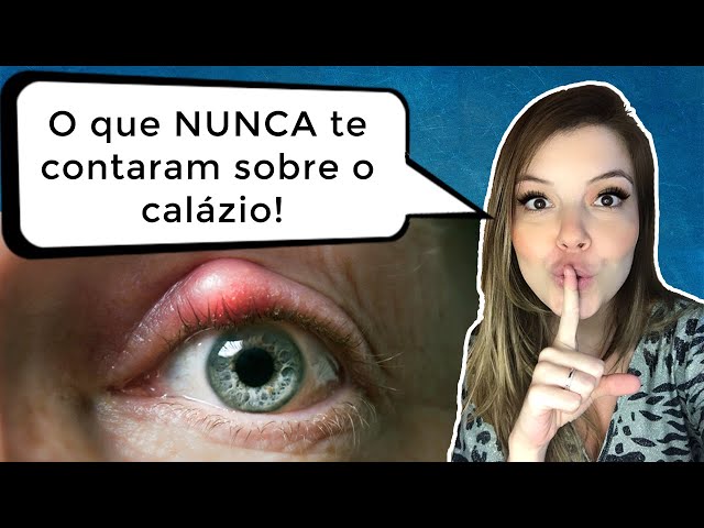 Hordéolo e Terçol: o que é, sintomas e tratamento - Dr. Gustavo Bonfadini 