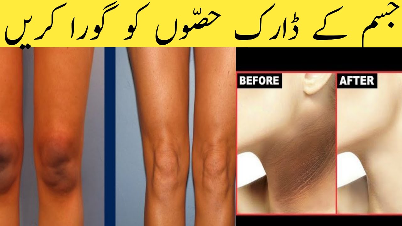How to Lighten Dark  Areas | Private Body Parts Whitening home remedy