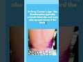 What Nurses Need to Know About Grey Turner's Sign