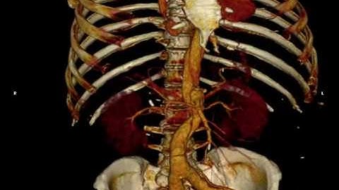 Virtopsy - CT angiography (Volume Rendering)