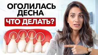 ДЕСНА «СПОЛЗАЕТ» с зубов! / ПРИЧИНЫ опущения десны и как его ОСТАНОВИТЬ?