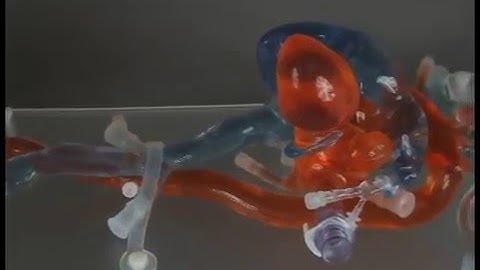 Patient Specific Heart Models