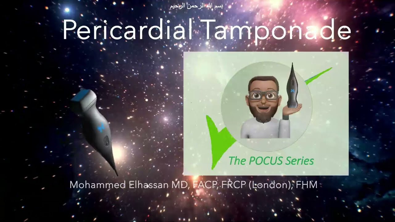 (Update) The POCUS Series - Pericardial Tamponade. The new ACC criteria for pericarditis.