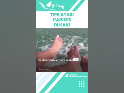 Tips Mengatasi Varises di Kaki dengan Mudah Tanpa Obat, Begini