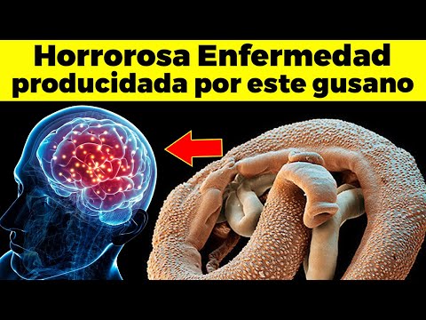 Video: ¿Son los síntomas de la esquistosomiasis?