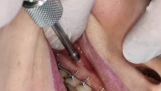 Mini screw, mini implant insertion , screwing in orthodontic mini_implant TAD