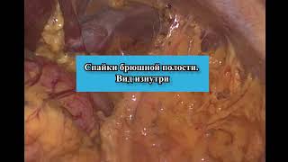 Спайки брюшной полости  Вид изнутри при проведении диагностической лапароскопии