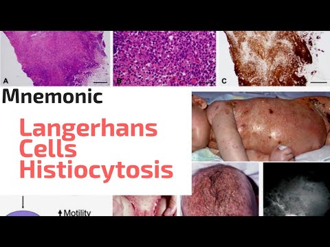 Mnemonic for Langerhans Cell Histiocytosis | Clinical & Pathological features