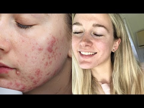 My Cystic Acne Story | Part One: Treatments + Lifestyle Changes