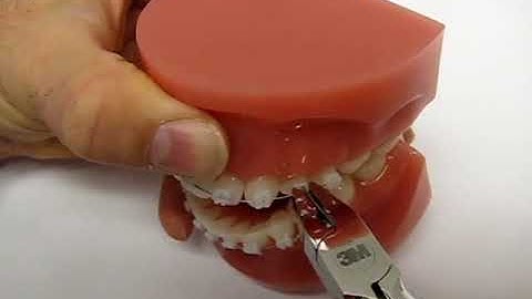 Debonding 3M™ Clarity™ Advanced Ceramic Brackets on the archwire