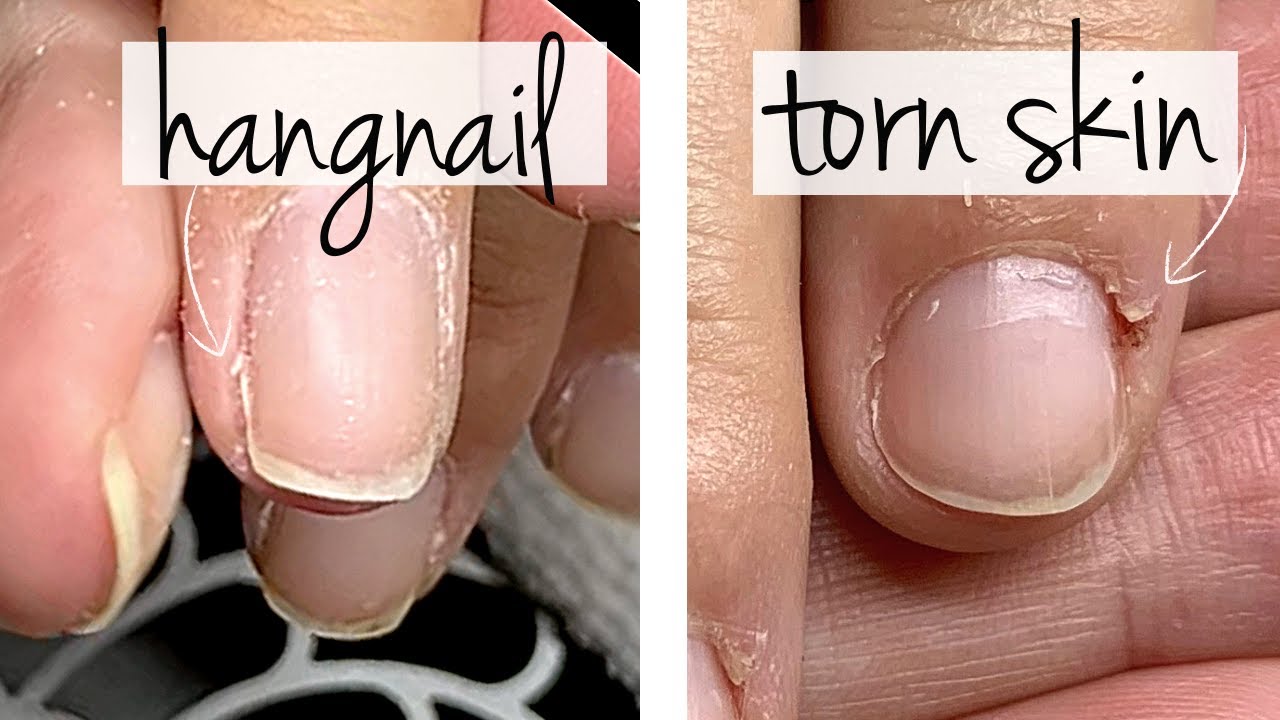 Hangnail - Wikipedia