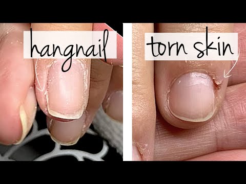 Hangnail Or Torn Skin