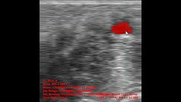 ImageViewer: Ultrasound Vessel Segmentation