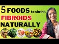 Fibroids Diet: 5 Foods to Naturally Reduce Uterine Fibroids