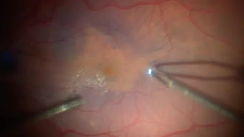 Retinal Surgery: removal of an epiretinal membrane (scar tissue on the surface of the retina)