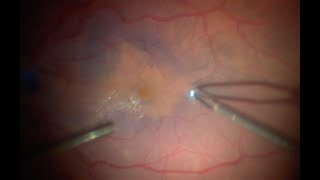 Retinal Surgery: removal of an epiretinal membrane (scar tissue on the surface of the retina)