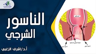 ما هو علاج الناسور الشرجي؟ - أ.د/ اشرف الزغبي