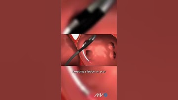 Atrial fibrillation catheter ablation