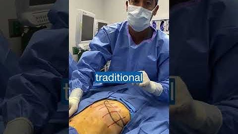 Reverse Tummy Tuck with Dr. Zuri in Miami | Zuri Plastic Surgery