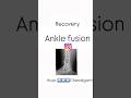 Ankle arthritis treatment/ Ankle fusion success / Ankle Pain / Dr Chandan narang foot surgeon
