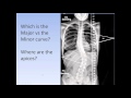 Scoliosis: How to medically classify scoliosis (the Lenke System for AIS)