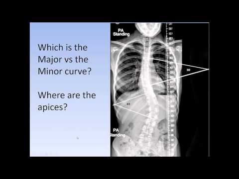 Video: Scoliosis - Degrees, Classification, Treatment, Prevention