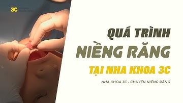 Quá trình gắn MẮC CÀI TỰ BUỘC DAMON Q2