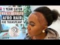 1 YEAR LATER - AFRO HAIR TRANSPLANT: Q&A + Results | Makeup By Sasha