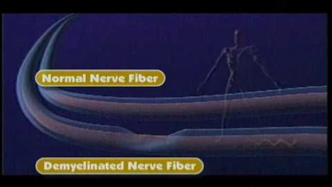 Types of Fatigue in MS - National MS Society - DayDayNews