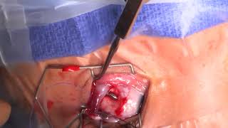 Bilateral Mr Recession And Bilateral Inferior Oblique Recession Dr. Rudolph Wagner