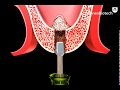 サイナスクレスタルアプローチキット (Sinus Crestal Approach Kit)