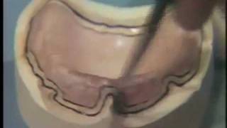 Custom Acrylic Resin Tray Construction: Maxillary Final Impression